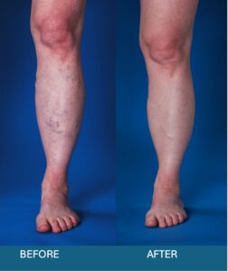 Is Varicose Vein Stripping Still the Gold Standard? If not, what’s new varicose vein treatment?